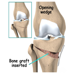 High Tibial Osteotomy Consultation with Dr. Jigar Desai