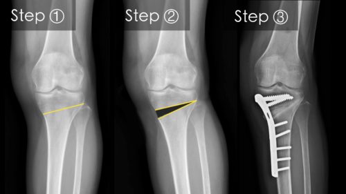 High Tibial Osteotomy Treatment by Dr. Jigar Desai