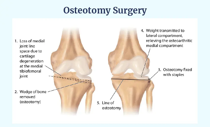 High Tibial Osteotomy Surgery