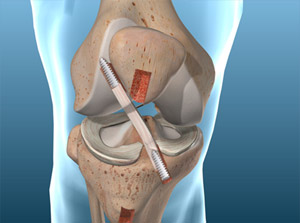 ACL Reconstruction