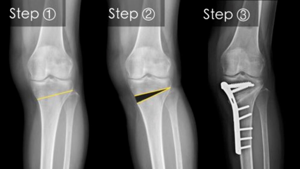 High Tibial Osteotomy